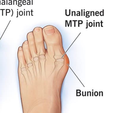 I've walked barefoot for 8+ years to avoid bunions