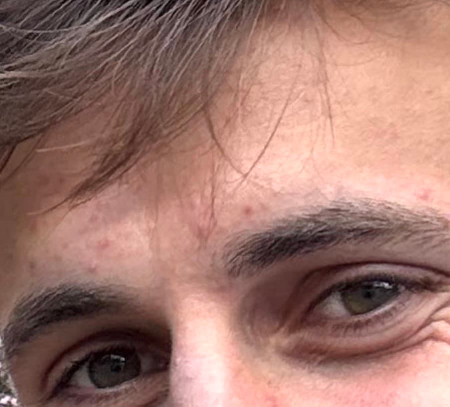 I stopped drinking tap water because it gives me pimples